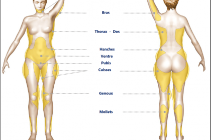 Liposuccion : remodeler sa silhouette