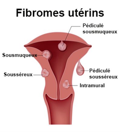 Qu&rsquo;en est-il du traitement des fibromes utérins courants ?