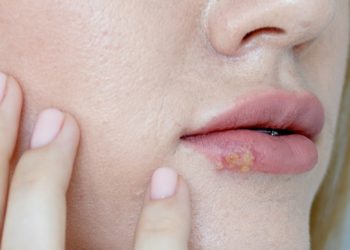 Comment éliminer l'herpès rapidement : méthodes naturelles et astuces efficaces