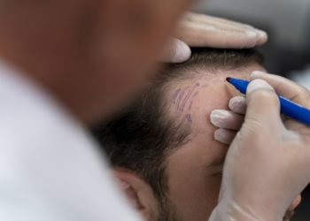 La greffe de cheveux en Turquie : une bonne idée ?